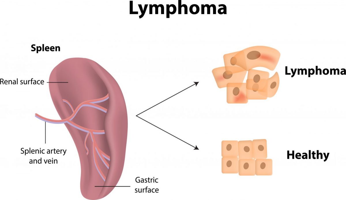 Lymphoma Symptoms What You Need To Know First Signs Of Lymphoma