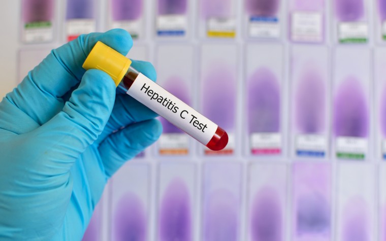 Head, neck cancers linked to hepatitis C