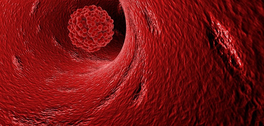 Blood Clots, Common Complication for Cancer Patients, May Be Result of Chemotherapy, Study Reports