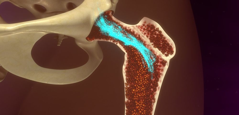 How Cells Around Bone Marrow Impact Lymphoma Transplant Success