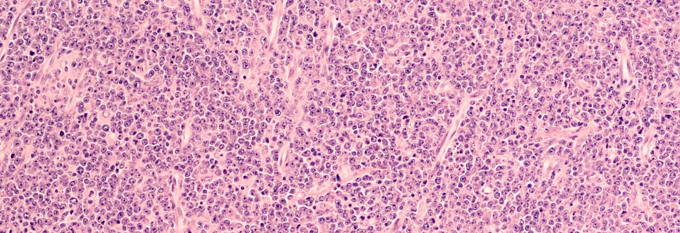 Gene Therapy-Based Cancer Treatment Delivers Promising Results in B-cell Malignancies, Study Shows